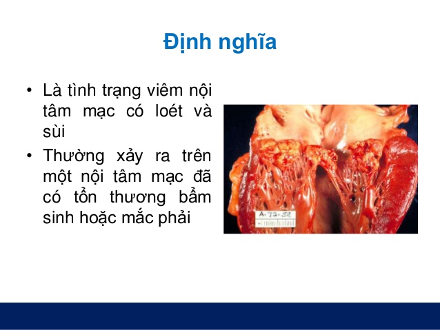 Viêm nội tâm mạc  - Hình ảnh minh họa